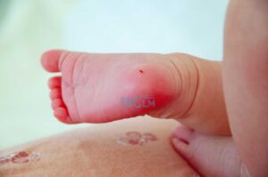 bebé nacimientos prueba del talón