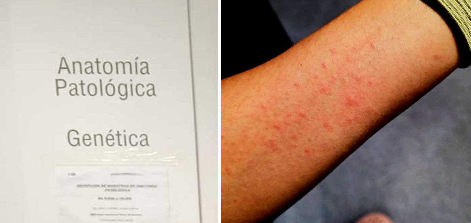 Imagen de eritemas en la piel, de Csif.