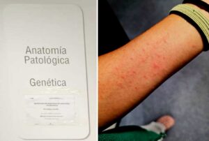 Imagen de eritemas en la piel, de Csif.