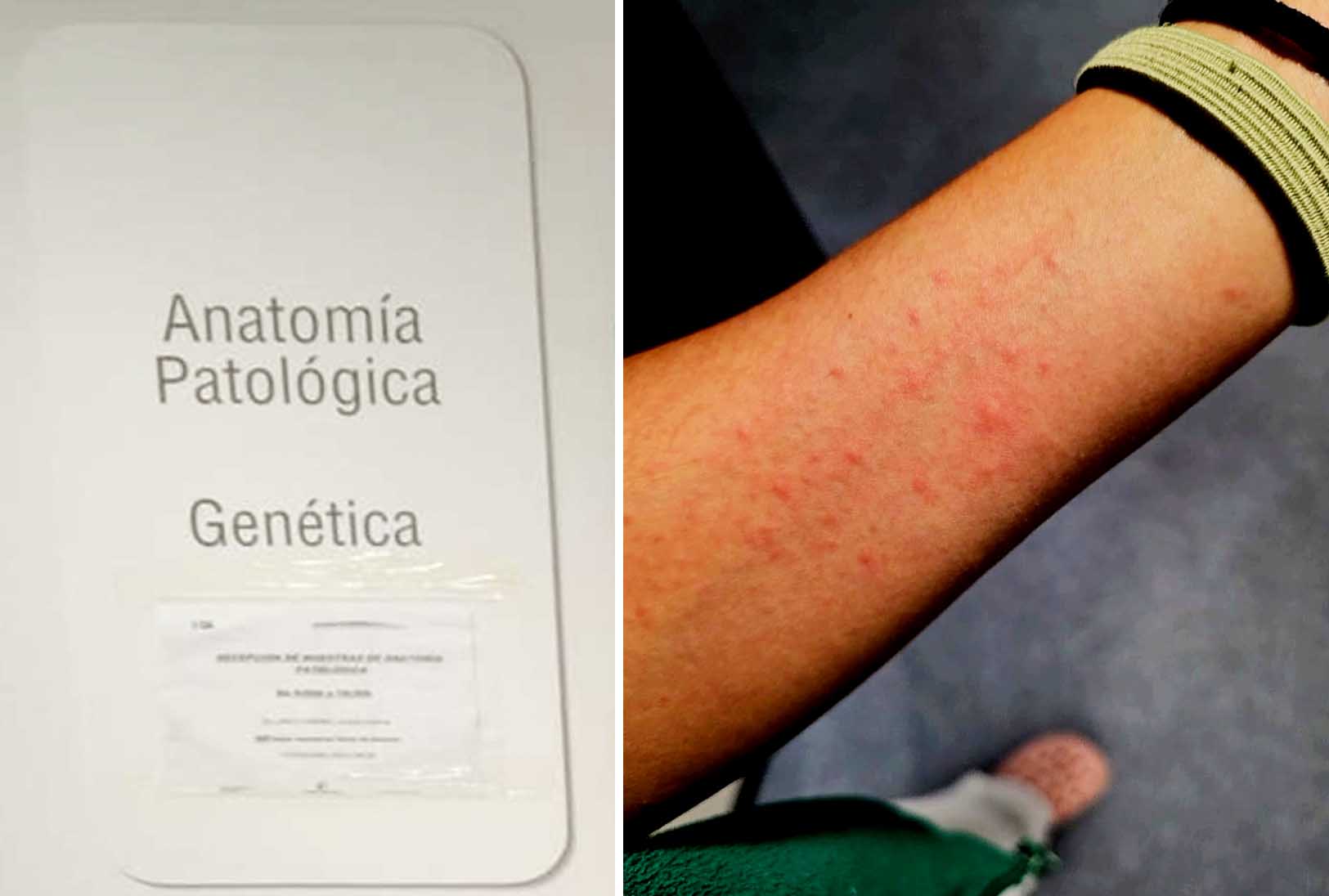 Imagen de eritemas en la piel, de Csif.